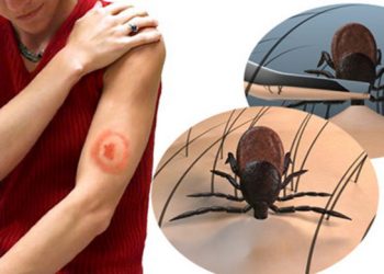 БНХАУ-д бүртгэгдсэн хачгаар дамждаг халдвараар долоон хүн нас баржээ