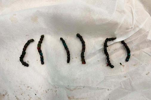 Соронз залгисан 4 настай хүүгийн ходоодонд мэс засал хийж 56 ширхэг соронз гарган авчээ