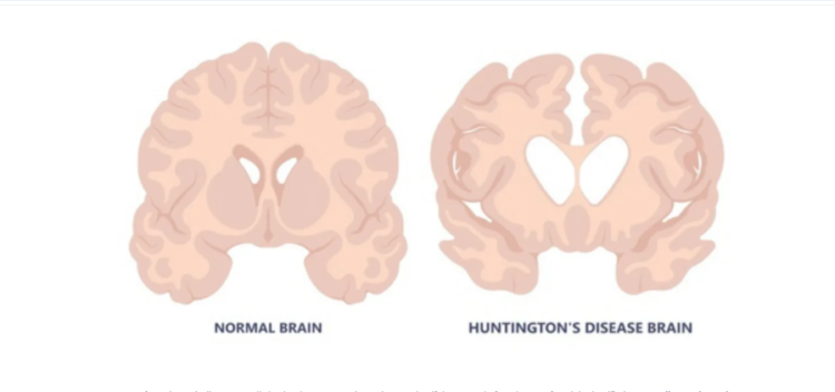 Хантингтоны өвчнийг эмчлэхэд “хувьсгал” гарлаа