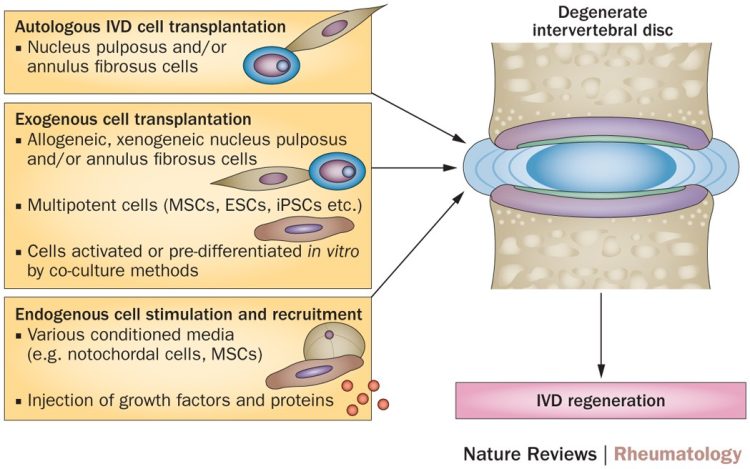Лабораторид өсгөсөн “нурууны диск” амжилттай болжээ