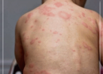 Менингококкт халдварын 5 тохиолдол батлагдаж, нэг хүн нас баржээ